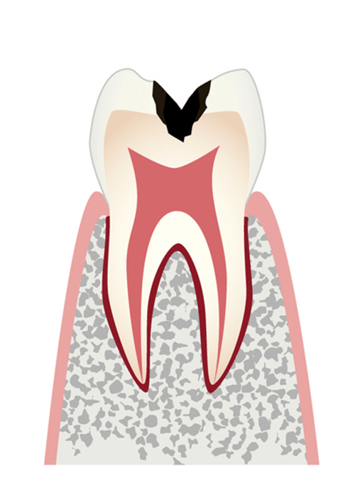 エナメル質のすぐ下にあり神経を守っている組織のむし歯