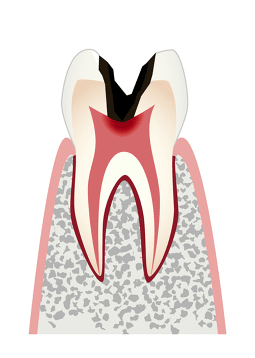 歯の神経まで達したむし歯