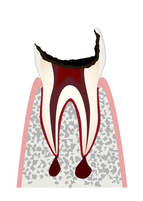 むし歯がかなり進行し歯の根っこだけが残った状態