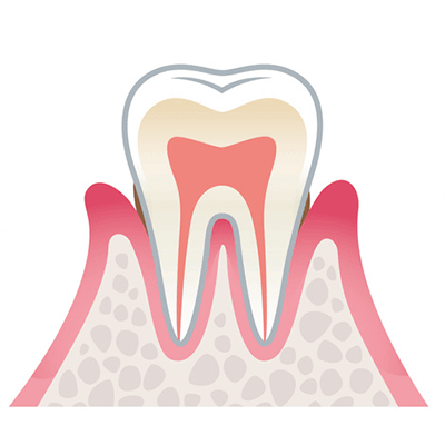軽度歯周炎