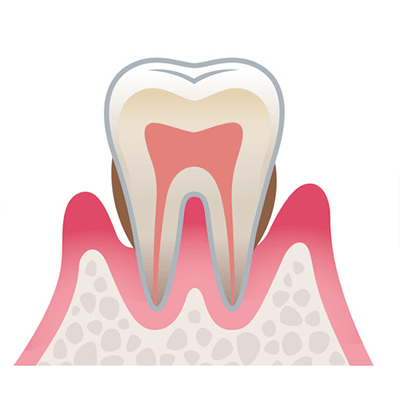 中等度歯周炎