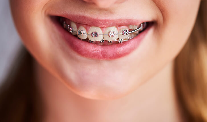 小児矯正（子どもの矯正）